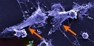 Researchers from NETwork suggests that the severity of COVID-19 may result from overactive neutrophils