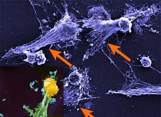 Researchers from NETwork suggests that the severity of COVID-19 may result from overactive neutrophils