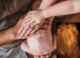 Fetal surgery to correct congenital spinal cord defects is more effective at healing neurological structure than surgery after birth