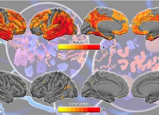 A newly blood test can distinguish Alzheimer’s disease from other tauopathies