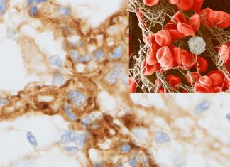 COVID-19 is associated with a unique type of blood clotting disorder