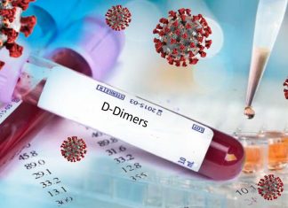 A D-dimer blood test is a useful way to identify COVID-19 patients at a higher risk of venous thromboembolism