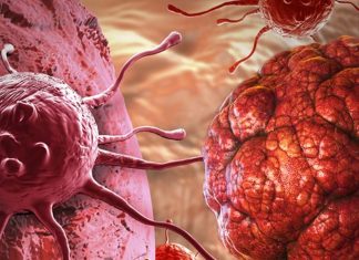 Lumefantrine is a potential novel approach for glioblastoma management