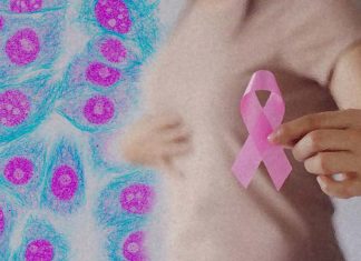 The RBBP8 gene has a crucial factor in the development of breast cancer in a group of very young women