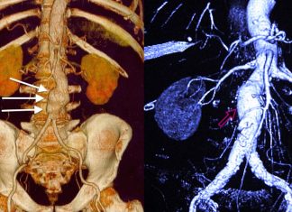 Patients with abdominal aortic aneurysm do not benefit from taking a common antibiotic drug to reduce inflammation