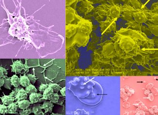 COVID-19 : An aerosolized version of tissue plasminogen activator (tPA) could treat blood clots