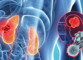 Researchers have identified factors influencing outcomes in kidney cancer treated with immunotherapy