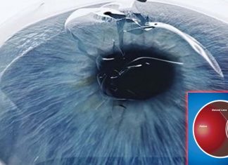 LiQD Cornea can treat corneal perforations without the need for transplantation