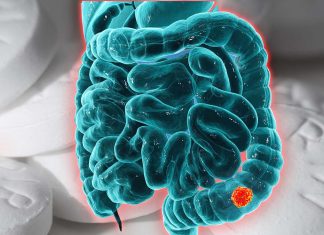 Two aspirins a day reduced the rate of bowel cancer by half