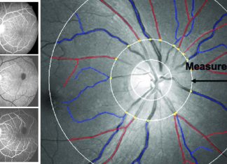 Young children with narrow retinal artery diameters have more likely to develop higher blood pressure