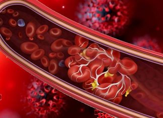 The TEG test can identify undetected blood clots in COVID-19 ICU patients