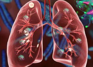 The cancer drug acalabrutinib reduced respiratory distress in COVID-19 patients