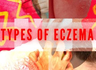 Eczema : skin lipids are an important protection