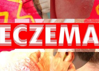Eczema: i lipidi della pelle sono una protezione importante
