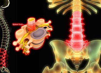 Nerve growth factor (NGF) may explain why some individuals experience more intense and chronic back pain