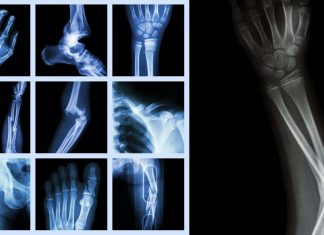 The repair of bone fractures requires the generation of nerve cells throughout the injured area