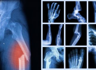 La riparazione delle fratture ossee richiede la generazione di cellule nervose in tutta l’area lesa
