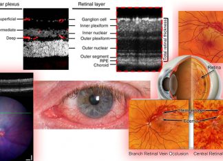 Researchers have developed eye drops that could prevent vision loss after retinal vein occlusion