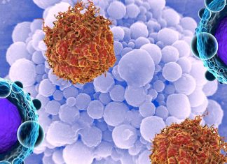 I ricercatori hanno sviluppato una tecnologia non invasiva che combina ultrasuoni e microbolle per distruggere le cellule tumorali