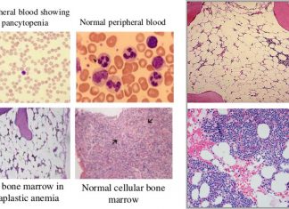 Bone Marrow Failure Syndrome : Spinal cord injuries cause stem cells in the bone marrow to rapidly divide