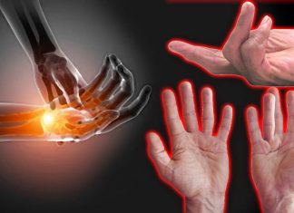 Dupuytren’s disease can be treat using Cytokine/JAK inhibitors