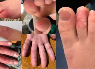 Researchers found that the SARS-CoV-2 virus was present in skin biopsies in children with symptoms of COVID toes