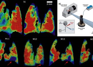 Using X-ray velocimetry (XV) is possible to measure the dynamics of airflow and detect cystic fibrosis lung disease