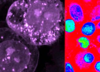 L’acido grasso chiamato DGLA può uccidere le cellule tumorali umane