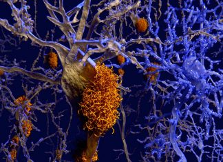 Alzheimer: repeated precipitation-dissolution events of salt crystals can accelerate the disease