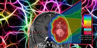 Una nuova tecnica di radioterapia per il trattamento del carcinoma cerebrale di alto grado – utilizza la radioterapia con micro-raggio personalizzata (MRT)