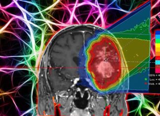 Una nuova tecnica di radioterapia per il trattamento del carcinoma cerebrale di alto grado – utilizza la radioterapia con micro-raggio personalizzata (MRT)
