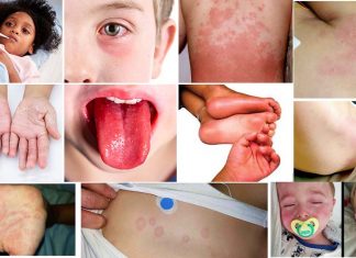 Understanding COVID-19 related multisystem inflammatory syndrome in children