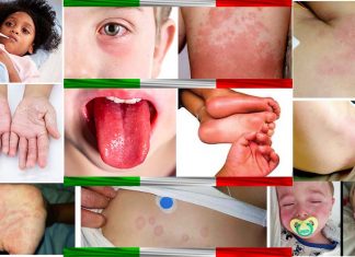 Comprensione della sindrome infiammatoria multisistemica correlata al COVID-19 nei bambini