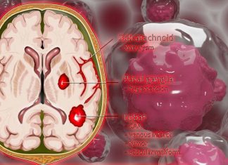 Researchers discovered how metastatic cancer is able to survive in the hostile subarachnoid space