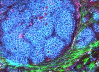 The tumor microenvironment (TME) can help cancers grow and evade the immune response