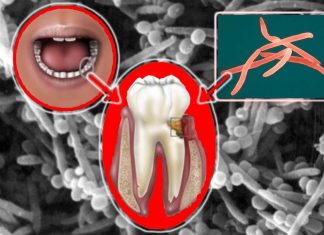 Oral bacteria Fusobacterium nucleatum can promote Bacterial vaginosis (BV)