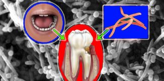 I batteri orali Fusobacterium nucleatum possono promuovere la vaginosi batterica (BV)