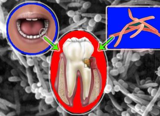 I batteri orali Fusobacterium nucleatum possono promuovere la vaginosi batterica (BV)
