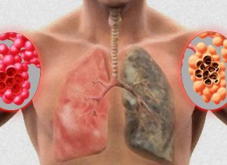 Emphysema: Small engineered peptide PR1P reduce apoptosis protecting the lung