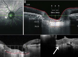 Stem cells in the region of the optic nerve enable preservation of vision
