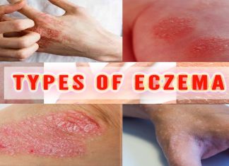 Eczema : two common variations in a gene called KIF3A are responsible for an impaired skin barrier