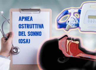 Apnea ostruttiva del sonno (OSA): nuova versione della chirurgia del palato