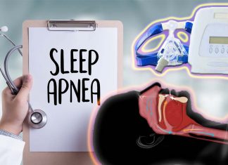 Obstructive sleep apnea (OSA): new version of palate surgery