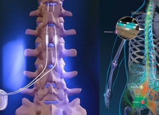 Spinal cord stimulation significantly decreased pain and reduced motor symptoms associated with Parkinson’s disease