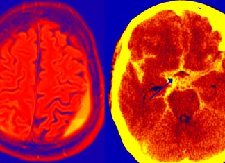 Subarachnoid hemorrhage (SAH) is linked with smoking
