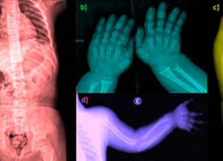New drug boosts bone growth in children born with achondroplasia