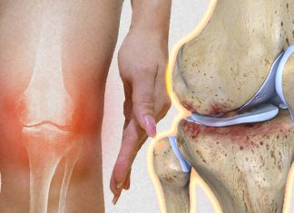 The pain experience in patients with knee osteoarthritis changes over time