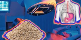 La crusca d’avena alimentare può compensare il danno gastrointestinale cronico causato dalla radioterapia