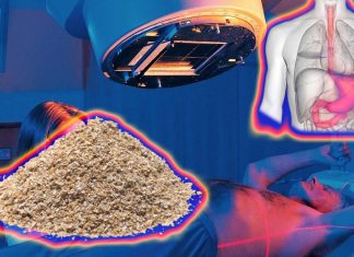La crusca d’avena alimentare può compensare il danno gastrointestinale cronico causato dalla radioterapia