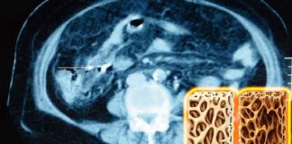 Certain type of sugar water be medicine for perforated bones
